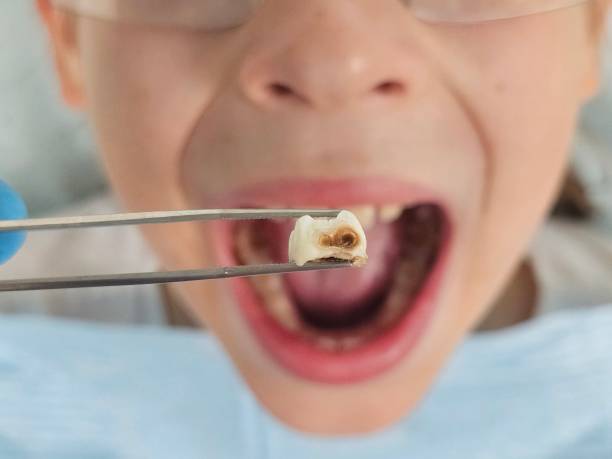 Best Emergency Treatment for Dental Infections or Abscesses in Cypress Landing, NC